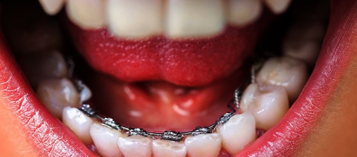 Lingual Braces Elite Orthodontics