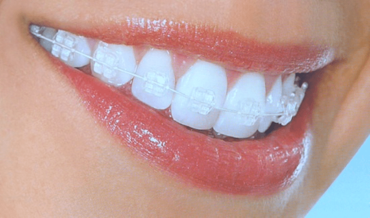 Clear Braces - Elite Orthodontics wayne NJ