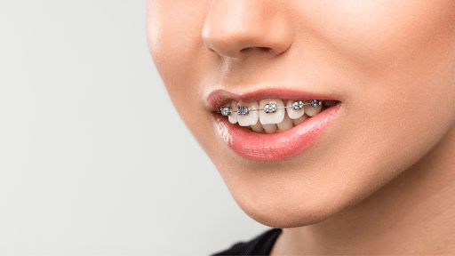 A patient is fitted with traditional braces, an effective correction method for overbites.