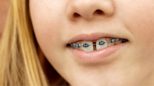 A young girl has braces for gap teeth.