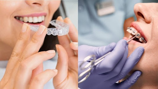 Two side-by-side images with one patient putting on Invisalign clear aligners and another patient getting their traditional braces examined by an orthodontist in Northern NJ.